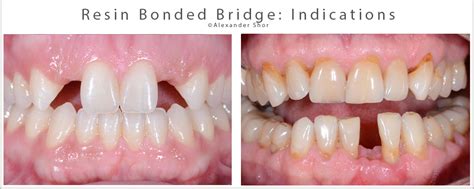 Resin Bonded Bridge Minimally Invasive Option For Tooth Replacement