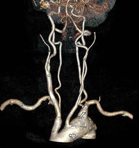 Computed Tomography Angiography Cta Volume Rendering Reconstruction