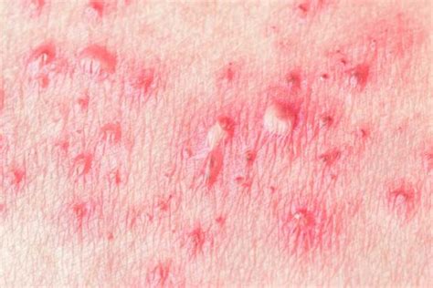 Shingles Everything You Need To Know To Treat Itor To Avoid It Altogether University Health News