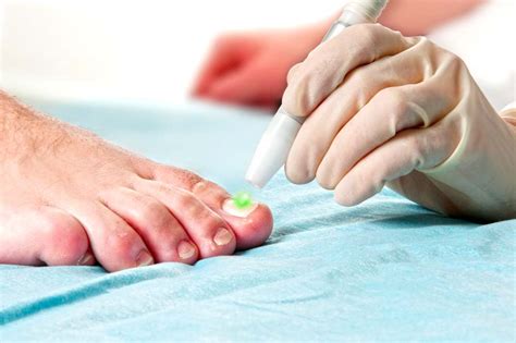Fungal Nails And Laser Therapy Hunter Podiatry Services