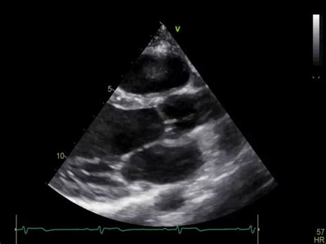 231 Parasternal Window Long Axis Views Plax 123sonography
