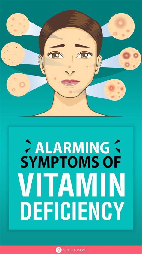 6 Symptoms Of Vitamin Deficiency That Show On Your Face Vitamin