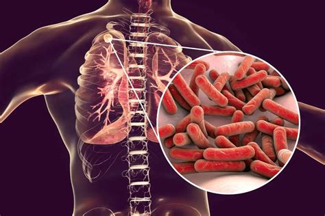new treatment approved for drug resistant tuberculosis biotech times