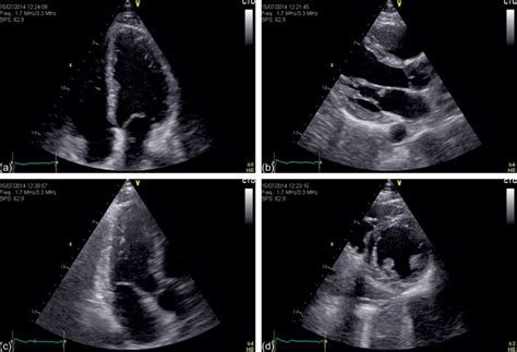 Myocarditis, also known as inflammatory cardiomyopathy, is inflammation of the heart muscle. Myocarditis | Radiology Key