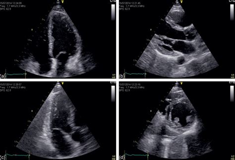 Myocarditis is an inflammatory disease of the myocardium that may present with sudden cardiac death, symptoms mimicking myocardial infarction, heart rhythm and conduction disorders, and heart failure. Myocarditis | Radiology Key