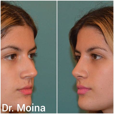 Nose Plastic Surgery Botox Nose Jobs Medical Face Beautiful Quick