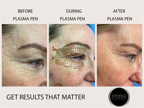 Plasma Pen Treatment Fibroblasting Enhance Skin And Brow