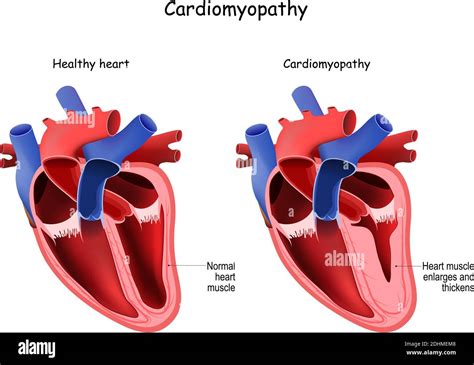 Cardiomyopathy Healthy Heart And Heart With Enlarged And Thickened