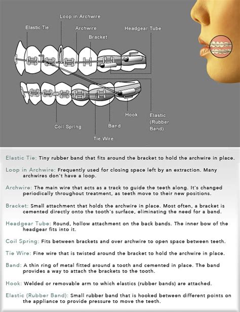 Braces Diagram Phoenix Az Butterfly Orthodontics