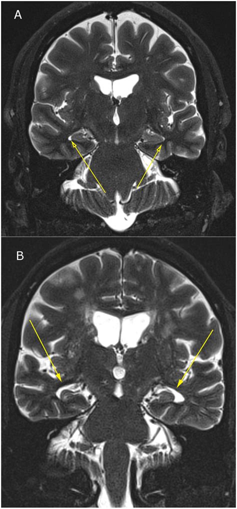3t Mri Of Inferior Lateral Ventricular Enlargement Due To Temporal Lobe