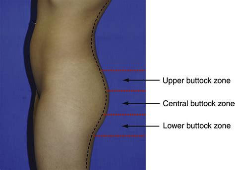 Gluteal Cleft Anatomy