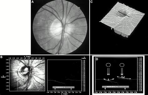 Blind Spot Size Depends On The Optic Disc Topography A Study Using Slo