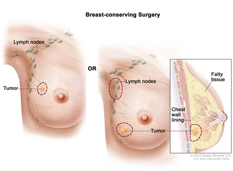 Maybe you would like to learn more about one of these? Breast Cancer Treatment (Adult) (PDQ®) (Patients ...