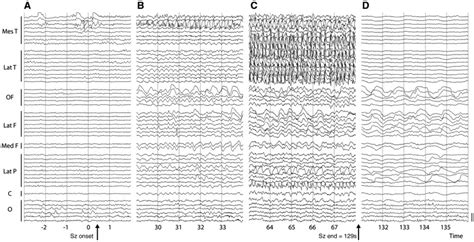 Example Intracranial Eeg Recording During A Temporal Lobe Download