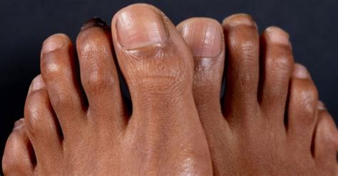 Hammer Toe Prevention And Treatment