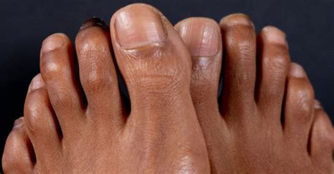 Hammer Toe - Prevention and Treatment | familydoctor.org