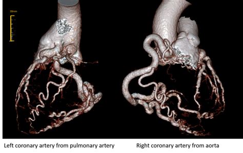 Direct Re Implantation Of Left Coronary Artery Into The Aorta In Adults