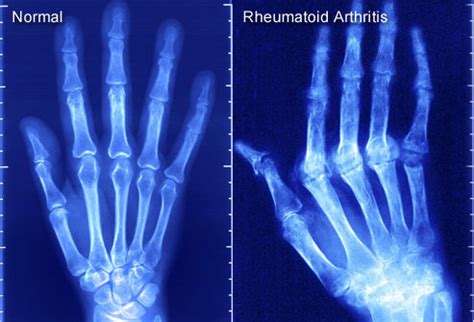 Imaging tests you may get. Visual Guide To Rheumatoid Arthritis
