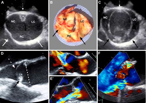 New Insights Into Unicuspid Aortic Valve Disease In Adults Not Just A