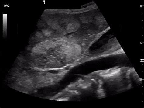 Liver Tumor Ultrasound