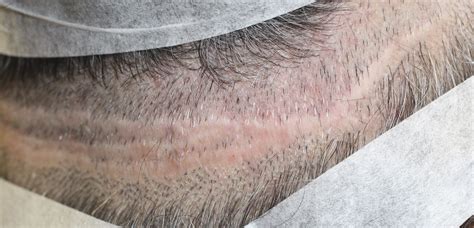 How Many Linear Donor Scars With Multiple Hair Transplant Procedures
