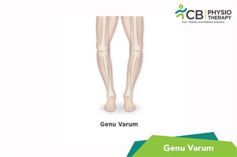 What Is Genu Varum Symptoms Causes Diagnosis And Physiotherapy