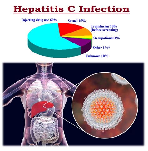Hepatitis C Sign And Symptoms Transmission Risk Factors Diagnosis