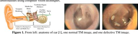 Figure 3 From Detecting Abnormalities In Tympanic Membrane Images