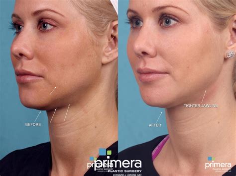Ultherapy® Before & After Photo Gallery | Orlando, Florida | Primera ...