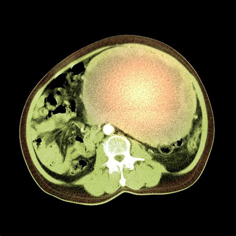Abdominal Sarcoma Photograph By Du Cane Medical Imaging Ltdscience