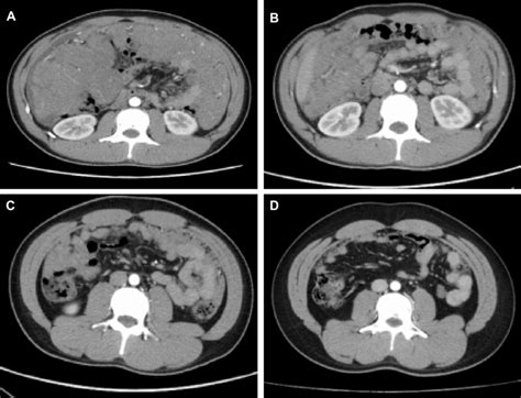 Whole Abdomen Ct Images Show Abdominal Mass Prior To Treatment A
