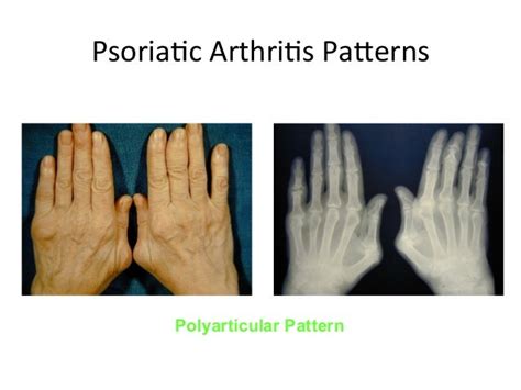 Psoriatic Arthritis Clinical Features And Epidemiology