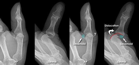 Trauma X Ray Upper Limb Gallery 2 Hand Thumb Dislocation