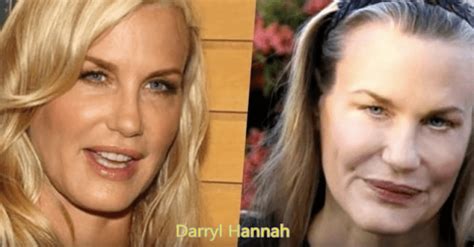 Craziest Before And After Plastic Surgery