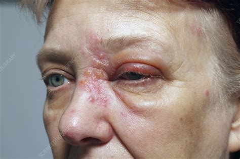 Top First Stage Early Stage Shingles Symptoms Phot Vrogue Co