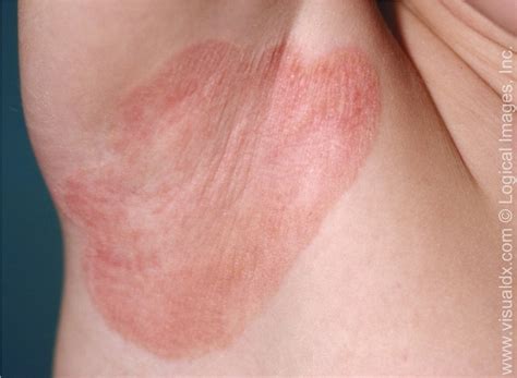 Plaque Psoriasis The Rash That Didnt Go Away Premier Md Care