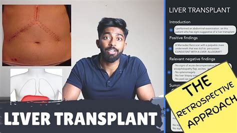 Osce Case Tutorial Liver Transplant Youtube