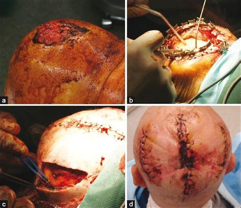 Giant Squamous Cell Carcinoma Of The Scalp A Clinical