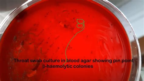 Throat Swab Culture On Blood Agar Showing Beta Haemolytic Streptococci
