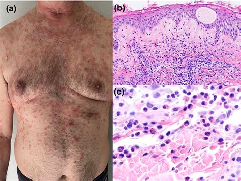 Eosinophilic Dermatosis After Astrazeneca Covid‐19 Vaccination