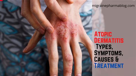 Atopic Dermatitis And Eczema Types Symptoms Causes And Treatment