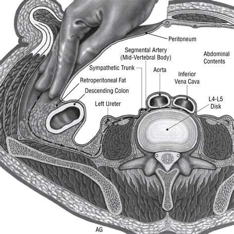 The Open Anterior Paramedian Retroperitoneal Approach For Spine