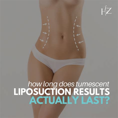 How Long Do Tumescent Liposuction Results Last Hz Plastic Surgery