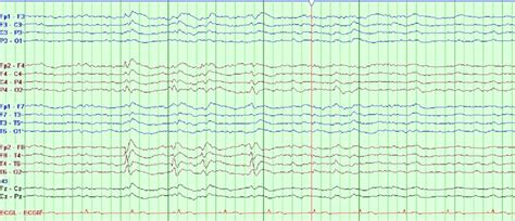 Sleep Deprived Eeg Demonstrating Interictal Sharp Waves In The Right