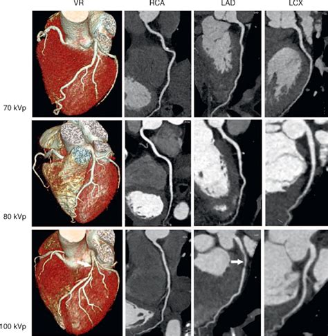 Ct Angiogram Heart And Brain