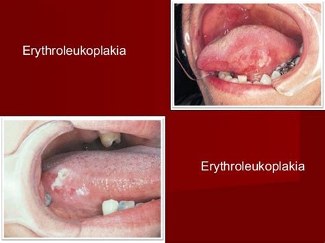 Erythroplakia On Lip