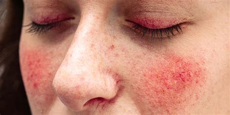 Facial Redness Treatment Bristol Ciao Bella Aesthetics