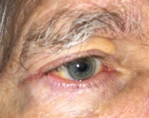 Eyelid Skin Cancer Treatment In Denver