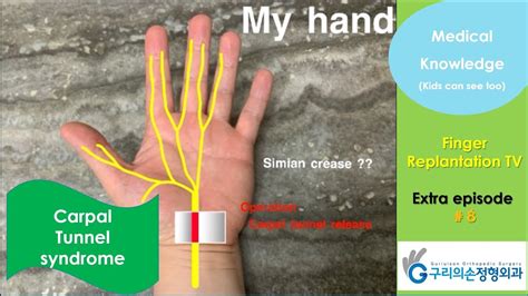 Carpal Tunnel Syndrome” Medical Knowledge Kids Can See Too