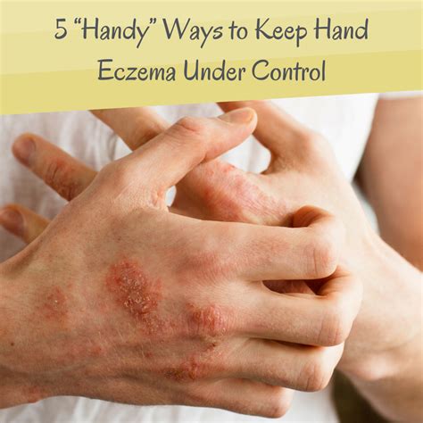 How To Treat Eczema On Hands How To Treat Dyshidrotic Eczema 12
